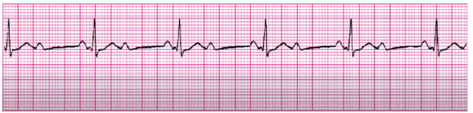 <p>anterior MI</p><p>monitor for worse block, especially MI (3rd degree or asystole)</p><p>temporary/perm pacer</p><p>hold anti-arrhythmic</p><p>NO ATROPINE - atropine increases SA node firing = P waves… we don’t need those</p>