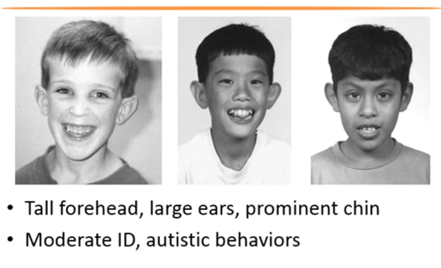 <p>An x-linked dominant disorder --&gt; caused by mutation to a gene on the X chromosome --&gt; causes moderate mental cognitive impairment</p>