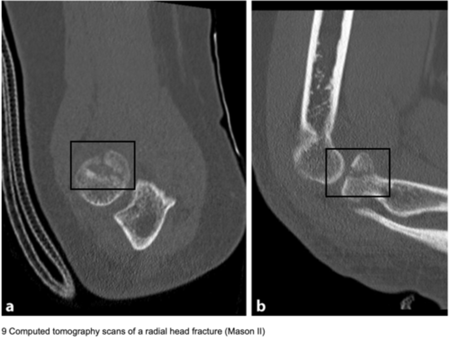 <p>CT images of the elbow can reveal conditions such as a fracture of the radius head.</p>