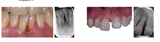 <p>At tooth level, the main determinants of risk include? (5)</p>