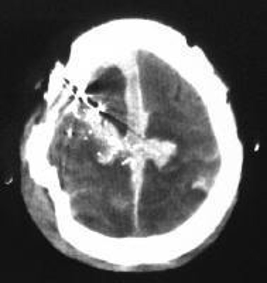 <p>Imaging test for diagnosing brain injuries.</p>