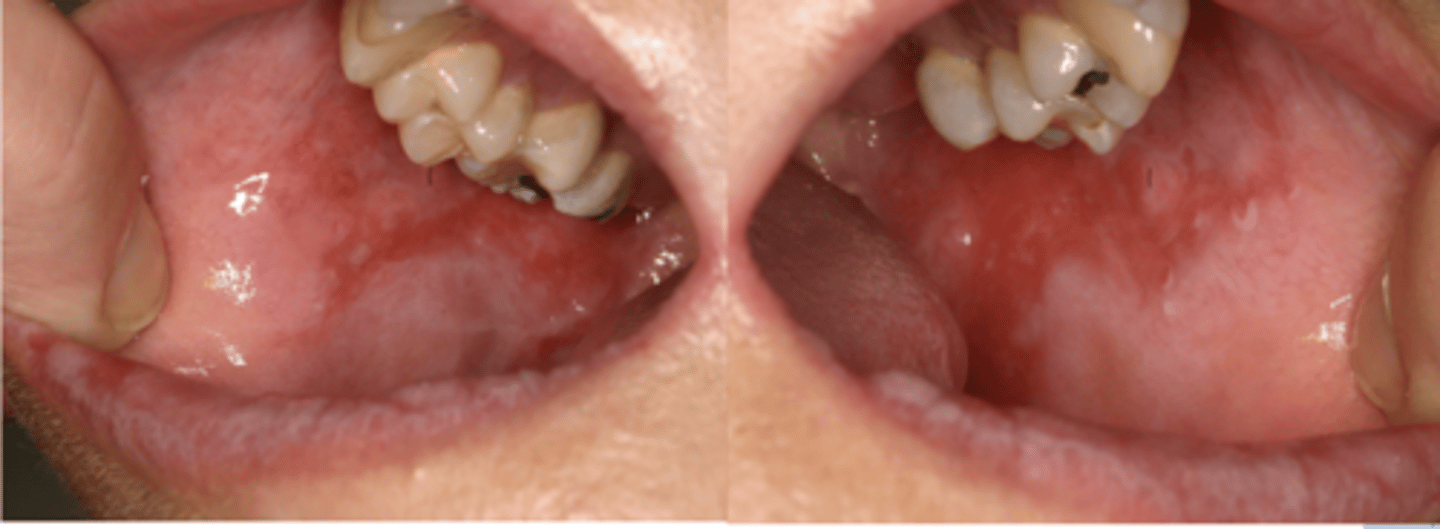 <p>Patient presents with these oral lesions and recently received an allogeneic hematopoietic stem cell transplant. What is the most likely differential?</p>
