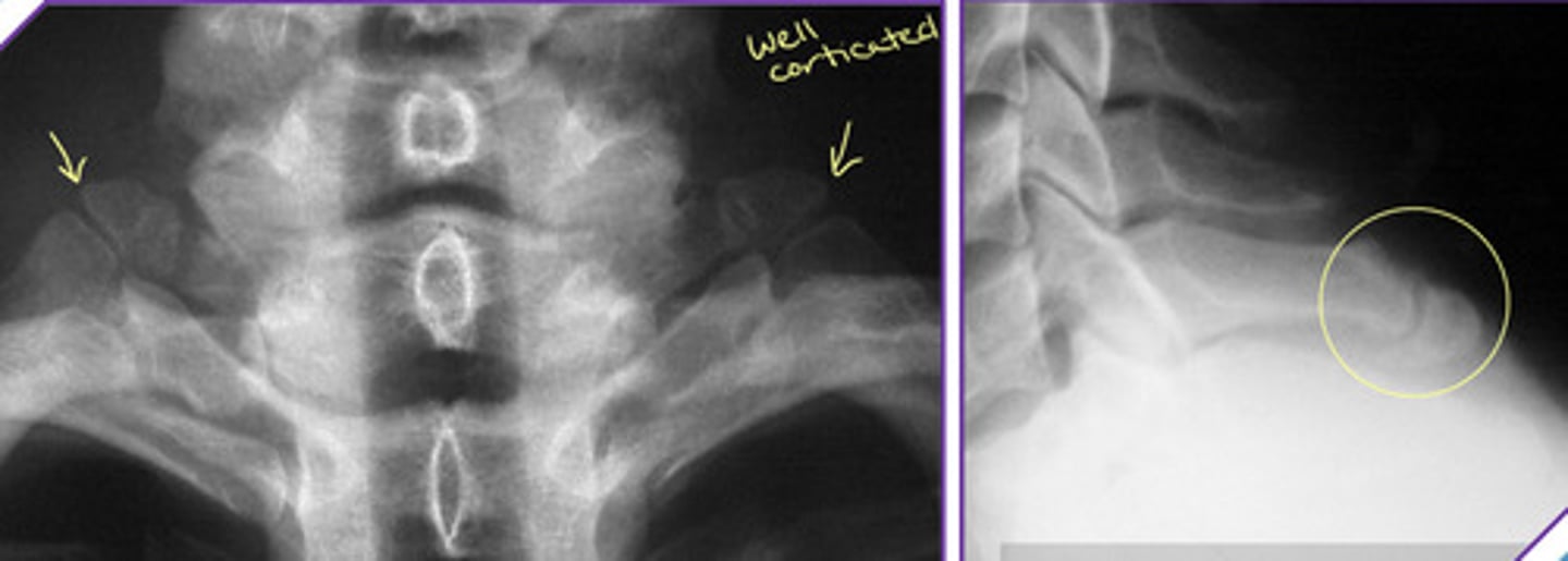<p>Reminder: apophysis = normal secondary ossification center that is located in the non-weight bearing part of the bone and eventually fuses over time</p>