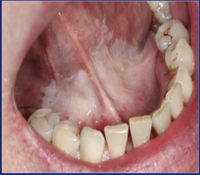 <p>Clinical term, no specific histology</p>