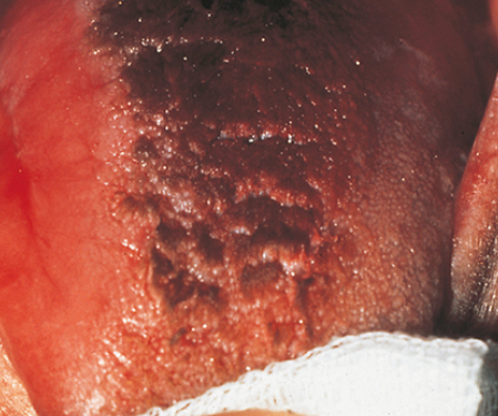 <p>38. What type of papillae is involved with the condition seen in Fig. 5.26?</p><p>a. Fungiform</p><p>b. Circumvallate</p><p>c. Foliate</p><p>d. Filiform</p>