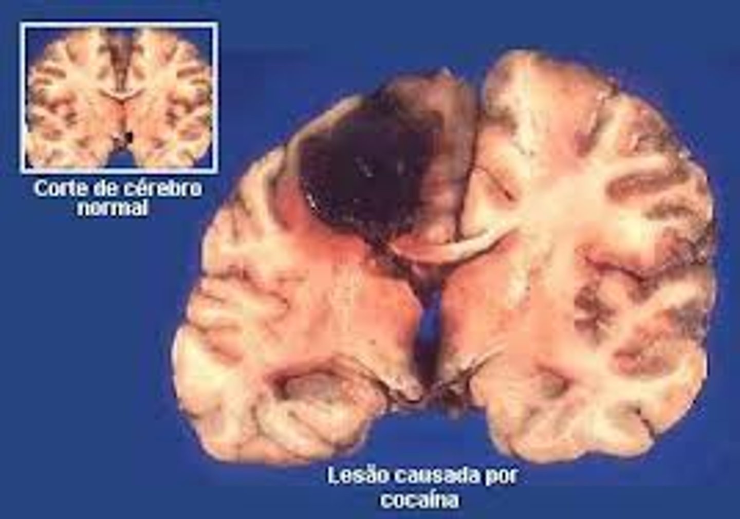 <p>a form of psychosurgery involving the removal or destruction of part of the brain</p>