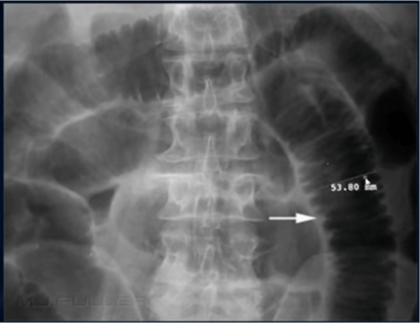 <p>-stack of coins</p><p>-closely stacked and extend across the lumen of the small bowel</p>