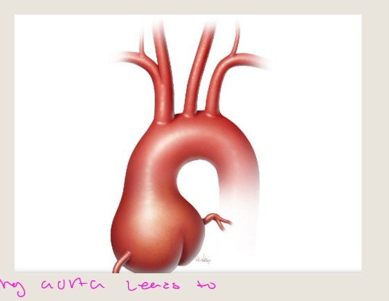 <p>Annuloaortic ectasia is a</p><p>condition that causes the</p><p>ascending aorta and aortic</p><p>annulus to widen, or dilate</p><p>Highly associated with</p><p>connective tissue disorders</p><p>like Marfan’s Syndrome</p>