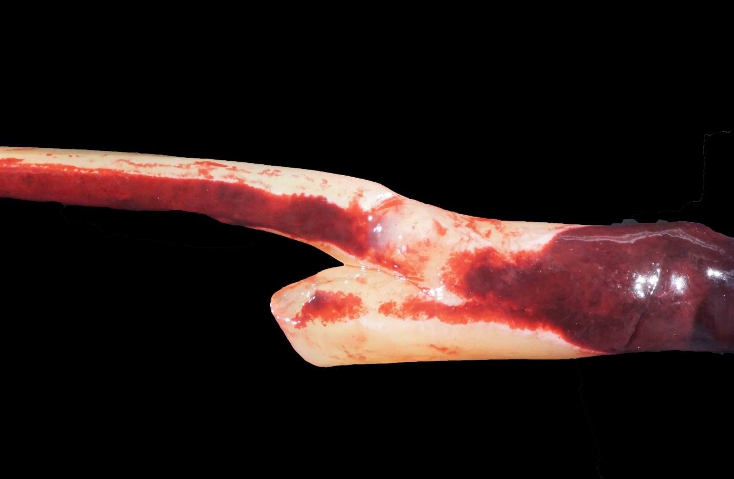 <p><span><span>The image shows a clot that would be described as elastic, smooth, and gelatinous and was easily removed from the vessel lumen (not adhered to the wall). This is an example of a _________ and represents a/an ________.</span></span></p><p>Antemortem thrombus (before death); incidental lesion</p><p></p><p>&nbsp;</p><p>Postmortem clot (after death); incidental lesion</p><p>&nbsp;</p><p>Postmortem clot (after death); postmortem artifact</p>