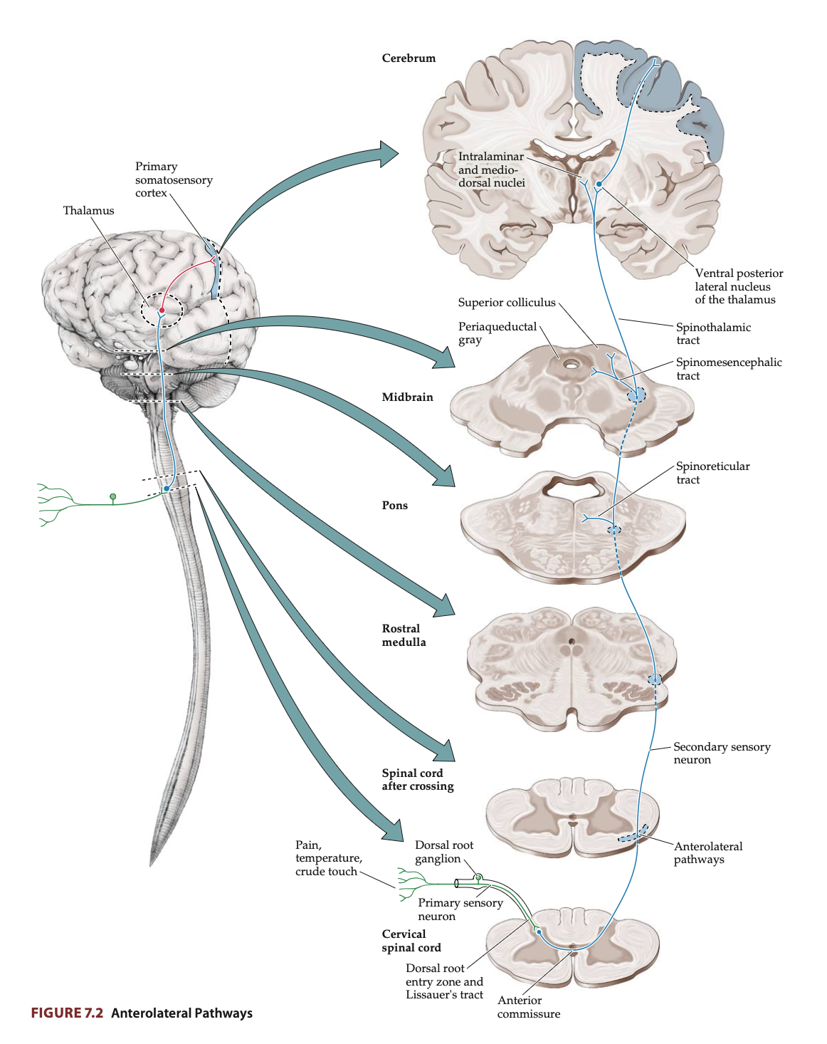 <p>Sensory pathways that ascend in the <strong>anterolateral column</strong> of the spinal cord and carry information related to <strong>crude touch, pressure, temperature,</strong> and <strong>pain</strong> from the peripheral nervous system to the central nervous system.</p><ul><li><p><strong>Spinothalamic Tract</strong></p><ul><li><p><strong>Neospinothalamic Tract </strong>(sharp localisable pain, temperature)</p></li><li><p><strong>Paleospinothalamic Tract </strong>(slow burning/aching pain, crude touch, pressure)</p></li></ul></li><li><p><strong>Spinoreticular Tract </strong>(emotional response to pain)</p></li><li><p><strong>Spinomesencephalic Tract</strong> (pain modulation/inhibition)</p></li></ul><p><strong>Functions</strong>:</p><ul><li><p><strong>Crude Touch and Pressure:</strong> Transmit sensations of general touch and pressure that lack fine discrimination.</p></li><li><p><strong>Pain Sensation (Nociception):</strong> Transmit information about tissue damage, allowing the body to perceive pain and initiate protective responses. </p></li><li><p><strong>Temperature Sensation:</strong> Convey information about changes in temperature, such as detecting heat or cold.</p></li></ul><p><strong>Pathway</strong>:</p><ul><li><p><strong>First-Order Neurons (Peripheral to Spinal Cord):</strong></p><p>Sensory receptors detect sensory information and send signals via neurons which send their axons through the <strong>dorsal roots</strong> to enter the <strong>spinal cord</strong>.</p></li><li><p><strong>Second-Order Neurons (Spinal Cord to Thalamus):</strong></p><p>These axons immediately synapse with <strong>second-order neurons</strong> in the <strong>dorsal horn</strong> of the spinal cord which then decussate in the <strong>anterior commissure</strong> of the spinal cord within a few segments of entry. After crossing, the fibres ascend in the <strong>anterolateral white matter</strong> of the spinal cord as part of the <strong>spinothalamic tract</strong>.</p></li><li><p><strong>Third-Order Neurons (Thalamus to Cortex): </strong>The second-order neurons terminate in the <strong>ventral posterolateral nucleus</strong> <strong>(VPL) </strong>of the <strong>thalamus</strong>. The thalamus then relays the information to the <strong>primary somatosensory cortex (S1)</strong> in the <strong>parietal lobe</strong>, where conscious perception of the sensory stimuli occurs. Some fibres also project to other thalamic nuclei and regions involved in the <strong>emotional</strong> and <strong>autonomic aspects of pain</strong>, such as the <strong>reticular formation</strong> and <strong>periaqueductal grey (PAG)</strong>.</p></li></ul><p><strong>Somatotopic Organisation</strong>: In the anterolateral pathways the feet are most lateral (<em>picture fibres from the anterior commissure adding on medially as the anterolateral pathway ascends in the spinal cord</em>).</p>