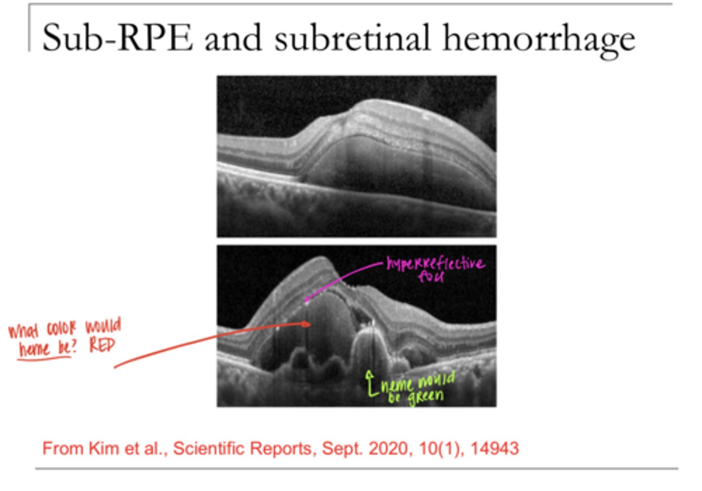 <p>Sub-RPE and subretinal hemorrhage on OCT (Pic)</p>