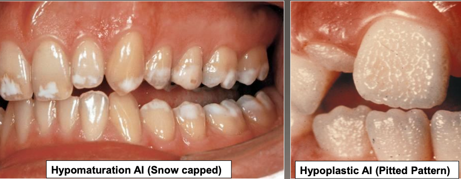 <ul><li><p>Yellow-brown to white pitted lesions</p></li><li><p>Open bite ,loss of contact</p></li><li><p>Types:</p><ul><li><p>Hypoplastic (pitted)</p></li><li><p>Hypomaturation /hypocalcification (snow capped)</p></li><li><p>AI with taurodontism</p></li></ul></li></ul><p></p>