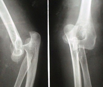 <p>Dislocation</p>