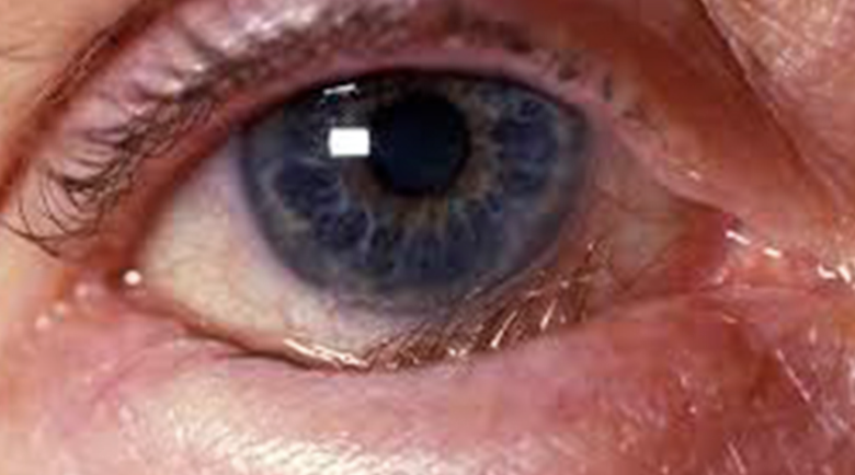 <p>Abnormal Findings in <strong><em>4. Position of the eyelids in comparison with the eyeballs</em></strong></p><ul><li><p>Inverted lower lid</p></li><li><p>May cause pain and injure the cornea as the eyelash brushes against the conjunctiva and cornea</p></li></ul><p></p>