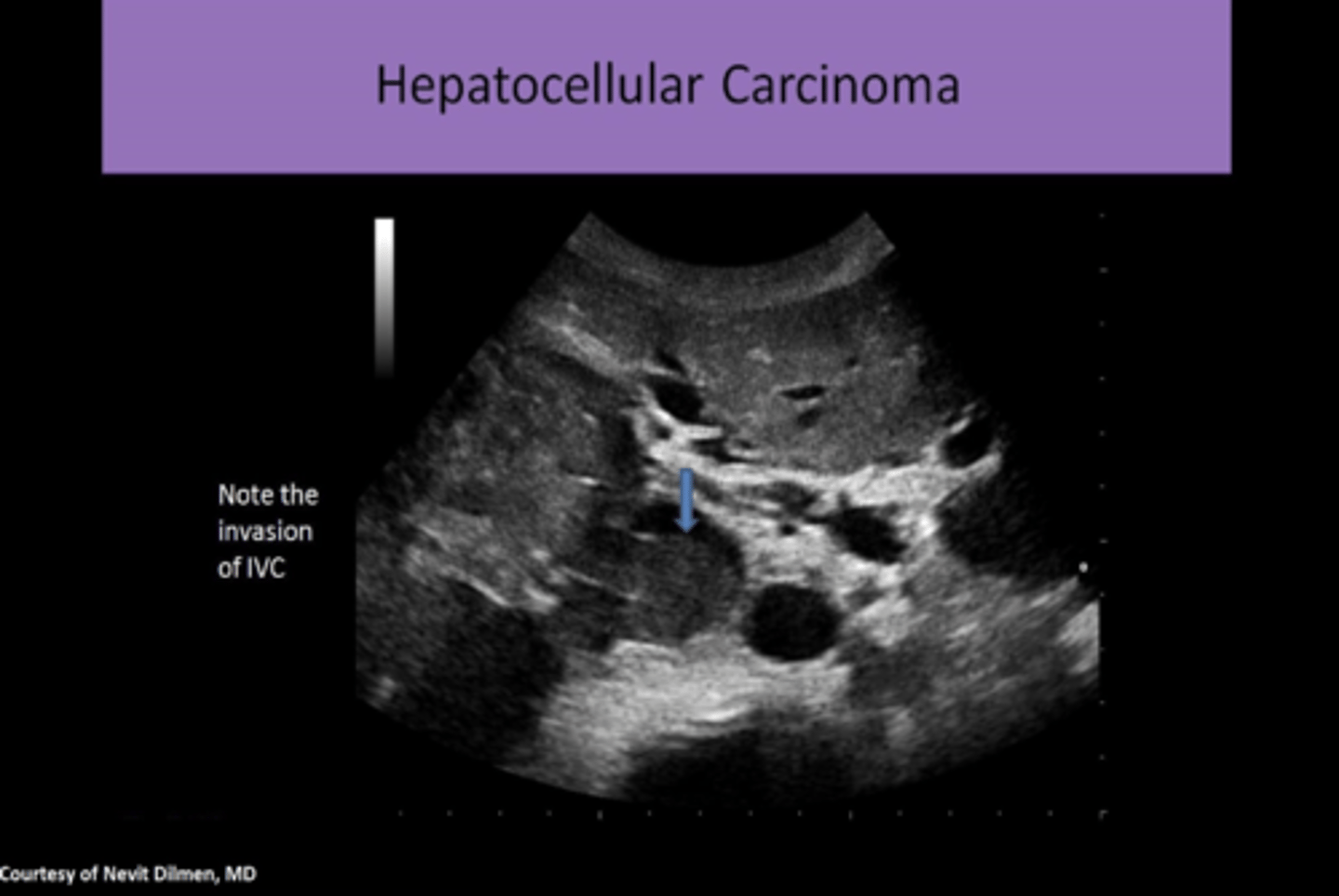 <p>1. FOCAL or MULTIFOCAL or DIFFUSE INFILTRATION OF CANCER CELLS<br>2. SOLID nodules LESS THAN 5 CM<br>3. VARYING ECHOGENICITY with CENTRAL SCAR<br>4. as mass ages, FIBROSIS AND NECROSIS CAUSES INCREASED HETEROGENEITY<br>5. HALO EFFECT (hypoechoic ring surrounding a hyperechoic central area)<br>6. HYPERVASCULAR<br>7. PORTAL VENOUS INVASION/THROMBOSIS<br>8. use COLOR DOPPLER to differentiate tumor invasion from thrombus<br>9. most malignancies are constantly growing and invading so this requires CONSTANT CONTINUOUS FLOW THROUGHOUT THE CARDIAC CYCLE<br>10. HIGH VELOCITY FLOW WITH INCREASED DIASTOLIC FLOW (low resistance waveform)<br>11. CONTRAST US- enhancement in arterial phase (areas of absence of contrast in the arterial phase correspond with areas of NECROSIS) and washout in portal venous phase</p>