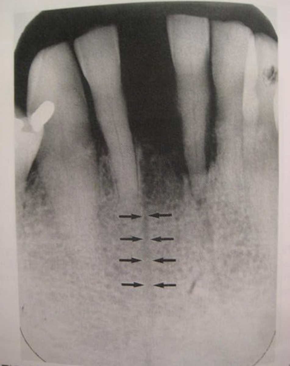 <p>What is the radiolucent structure seen here?</p>