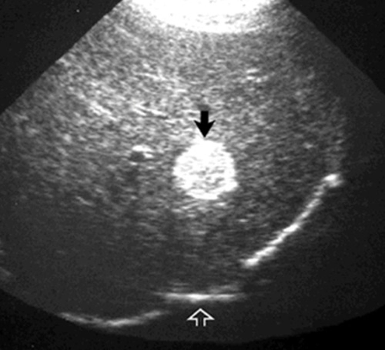 <p>Fatty tumor</p><p>Hyperechoic, circumscribed, good margins</p><p>cause velocity artifact - diaphragm does not seem complete</p>