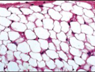 <ul><li><p>Large empty looking cells</p></li><li><p>Often pale</p></li><li><p>Subcutaneous fat</p></li></ul><p></p>