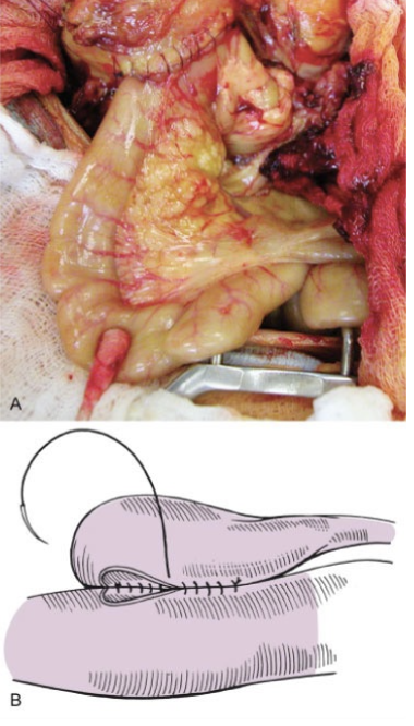 <p>- Anastomosis of gall bladder to intestine to reroute biliary system, either to duodenum (preferred; Cholecystoduodenostomy) or jejunum (Cholecystojejunostomy)</p>