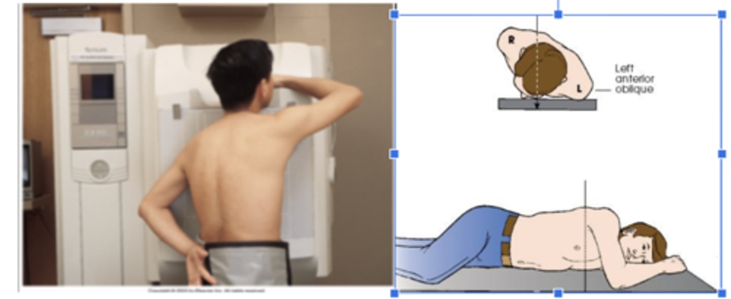 <p>A patient placed in the X position for PA oblique projection of the chest</p>