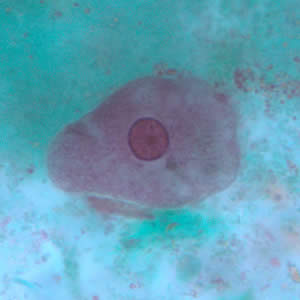 <p>Identify this 20 µm amebic trophozoite.<br><br></p><p>Entamoeba coli</p><p>Entamoeba hartmanni</p><p>Entamoeba histolytica</p><p>Entamoeba polecki</p><p>None of the above</p>