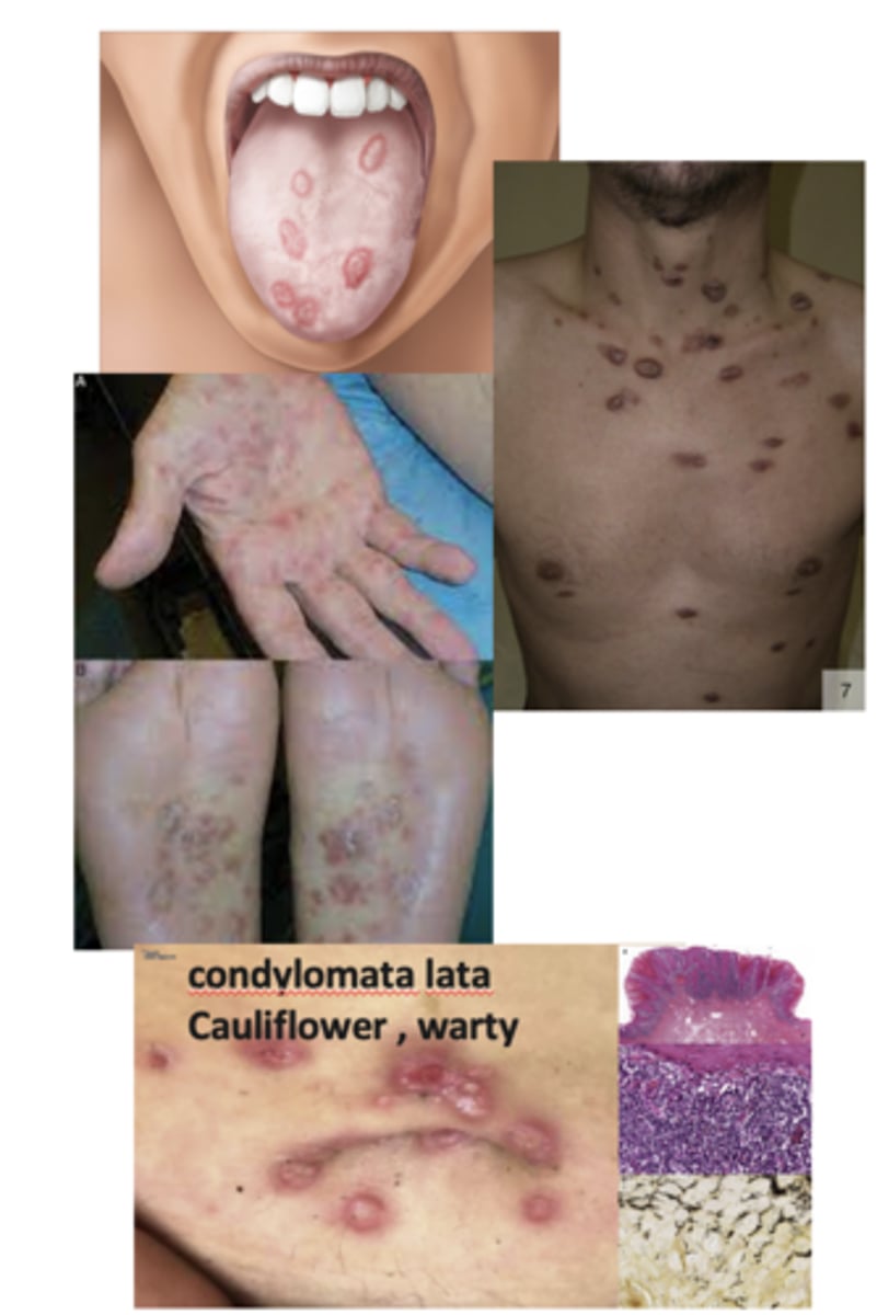 <p>What happens to the infected person as lesions resolve spontaneously, and explain?</p>