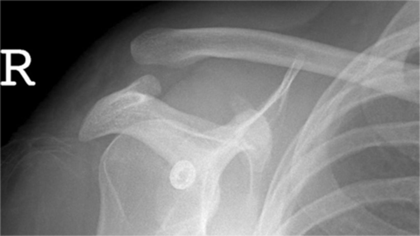 <p>Which grade ACJ separation would this be considered?</p>