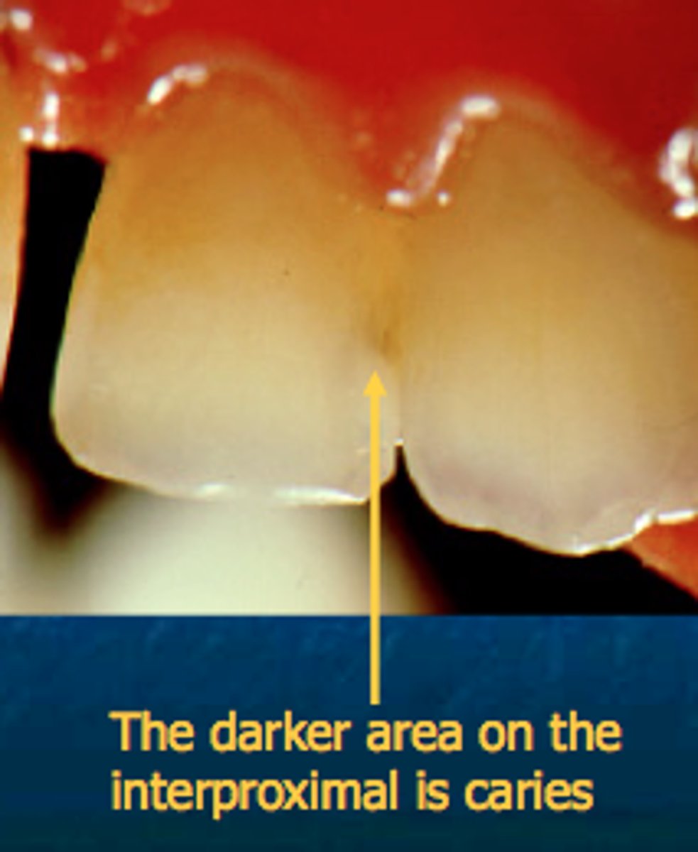 <p>proximal, anterior teeth</p>
