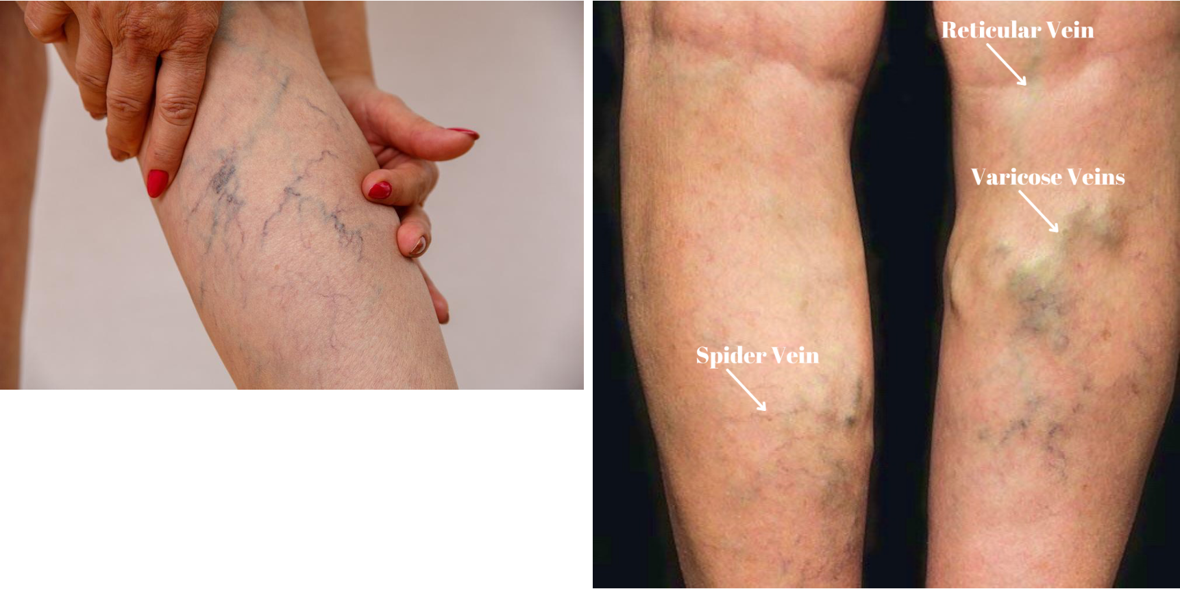 <p>Reticular Veins measure <u>       </u>, while spider veins are less than <u>       </u>in size; many texts say Reticular Veins= <u>      </u></p>