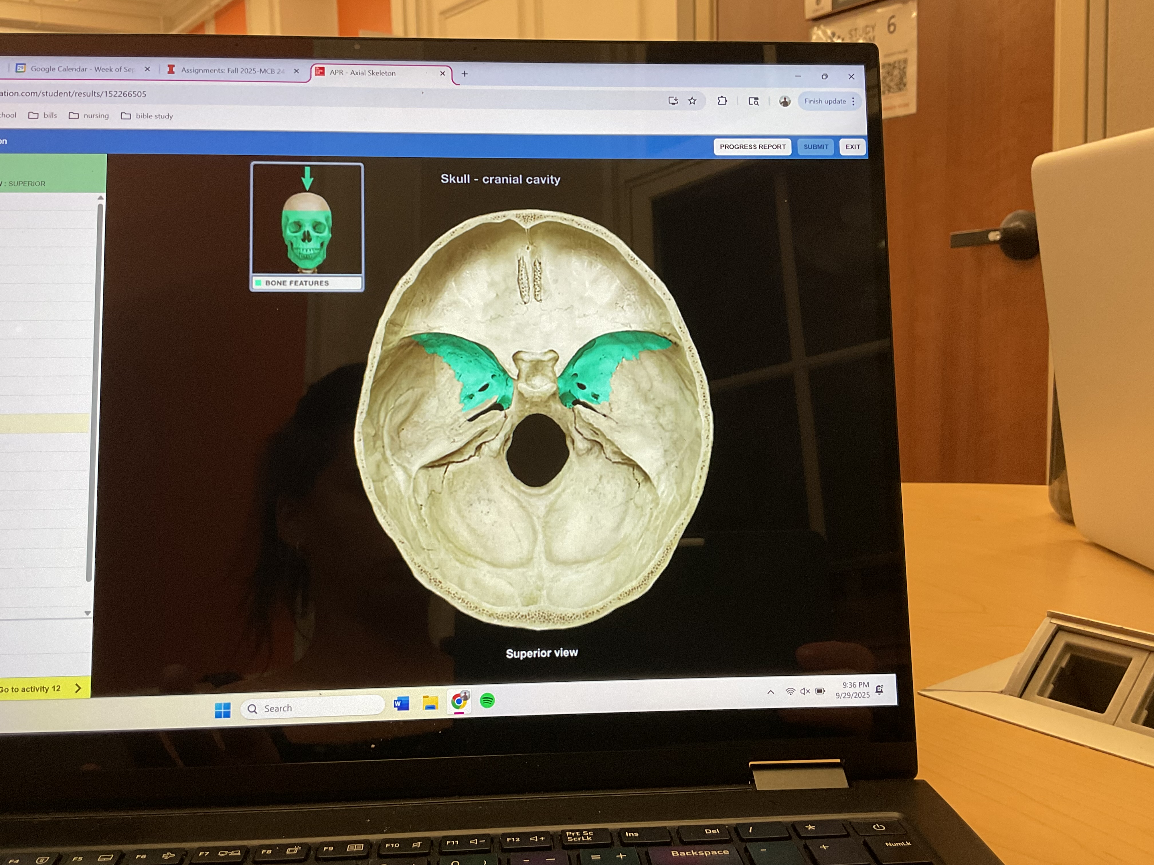 <p>Greater wing of sphenoid bone </p>
