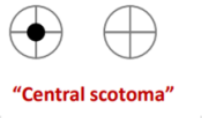 <p>A patient presenting with this visual defect likely has a lesion where</p>
