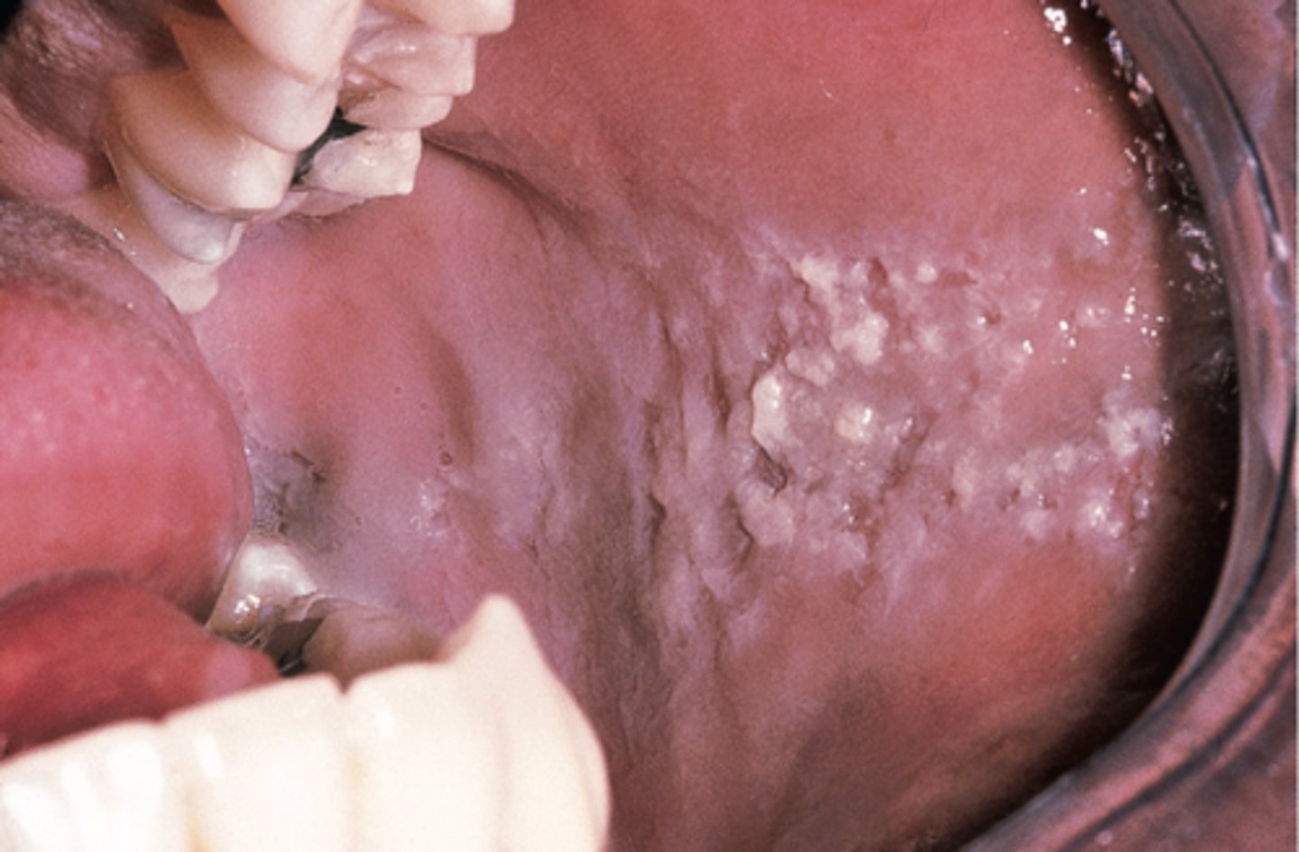 <p>along occlusal</p><p>bilateral / symmetrical</p><p>shaggy</p>