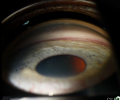<p>what is the finding shown in this image? </p>