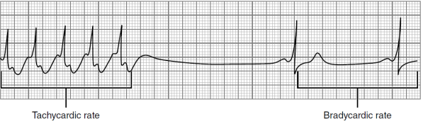 <p>What does this EKG show?</p>