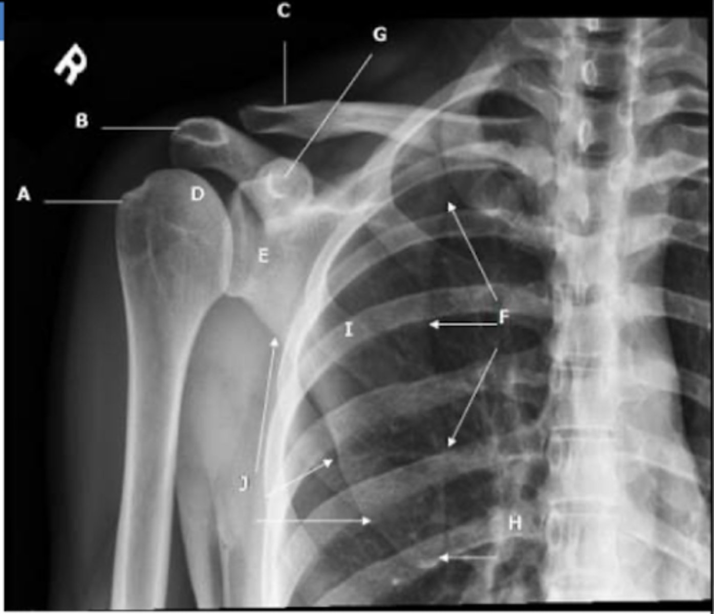 <p>A → greater tubercle</p><p>B → acromion</p><p>C → clavicle</p><p>D → humeral head</p><p>E → glenoid process</p><p>F → medial/vertebral border of the scapula</p><p>G → coracoid process</p><p>H → inferior angle of scapula</p><p>J → axillary/lateral border of scapula</p>