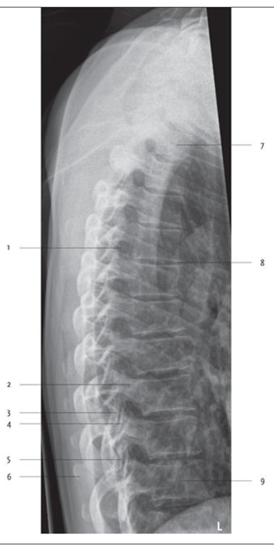 <p>Articulatio intervertebralis</p>
