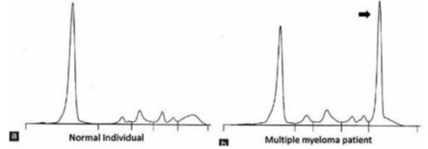 <p>In plasma cell disorders, the production of very high numbers of immunoglobulins or M proteins results in a characteristic spike at the gamma-globulin region. What do you call this spike?</p>