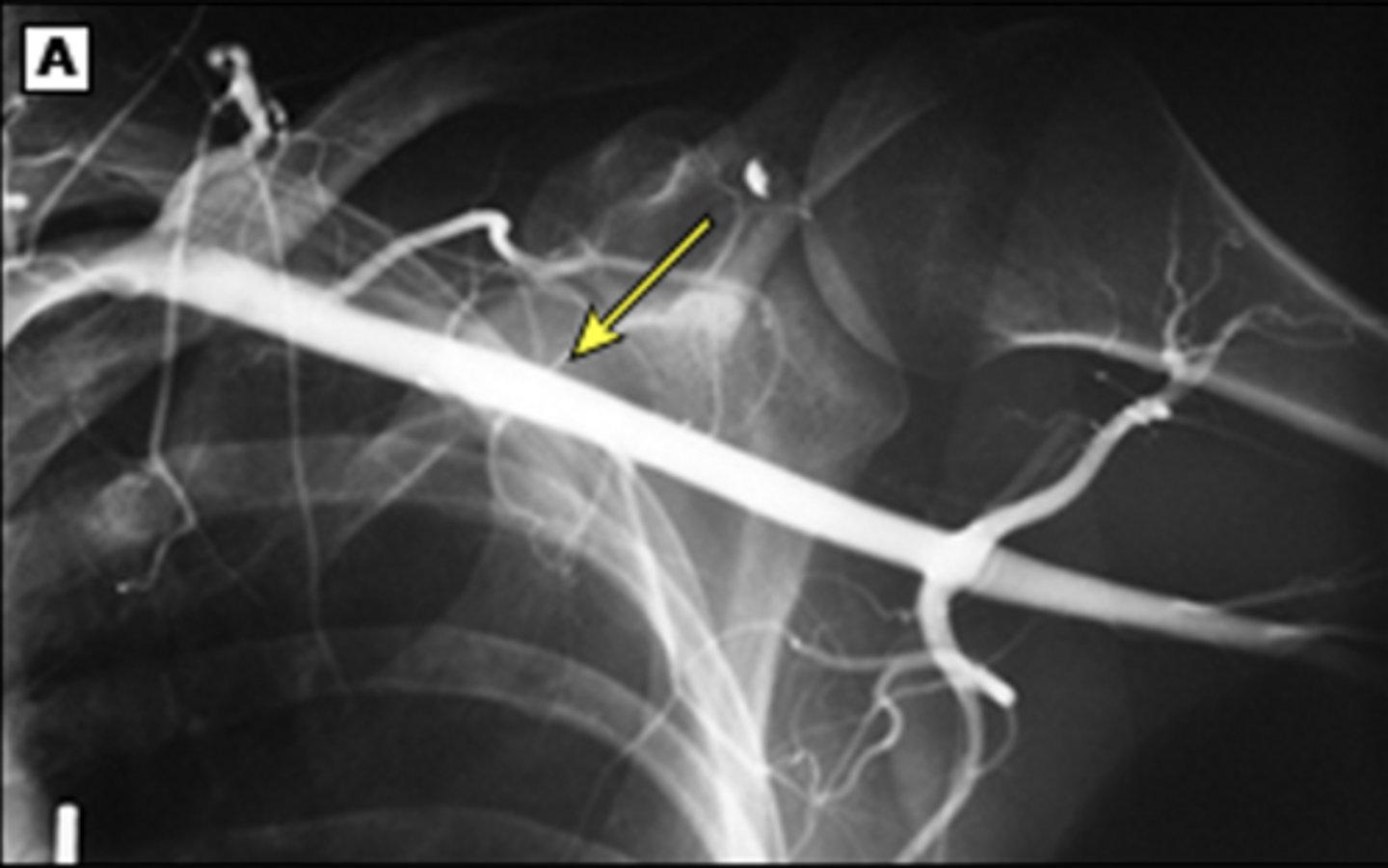 <p>In cases of suspected embolic disease or arterial aneurysm</p>
