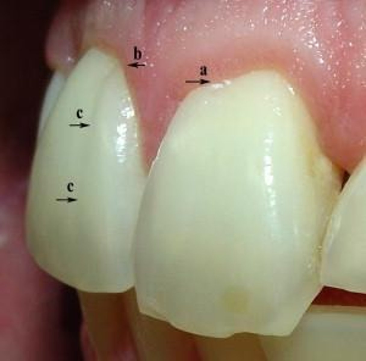 <p>the stable anatomical demarcation of teeth defined as the cementoenamel junction</p>
