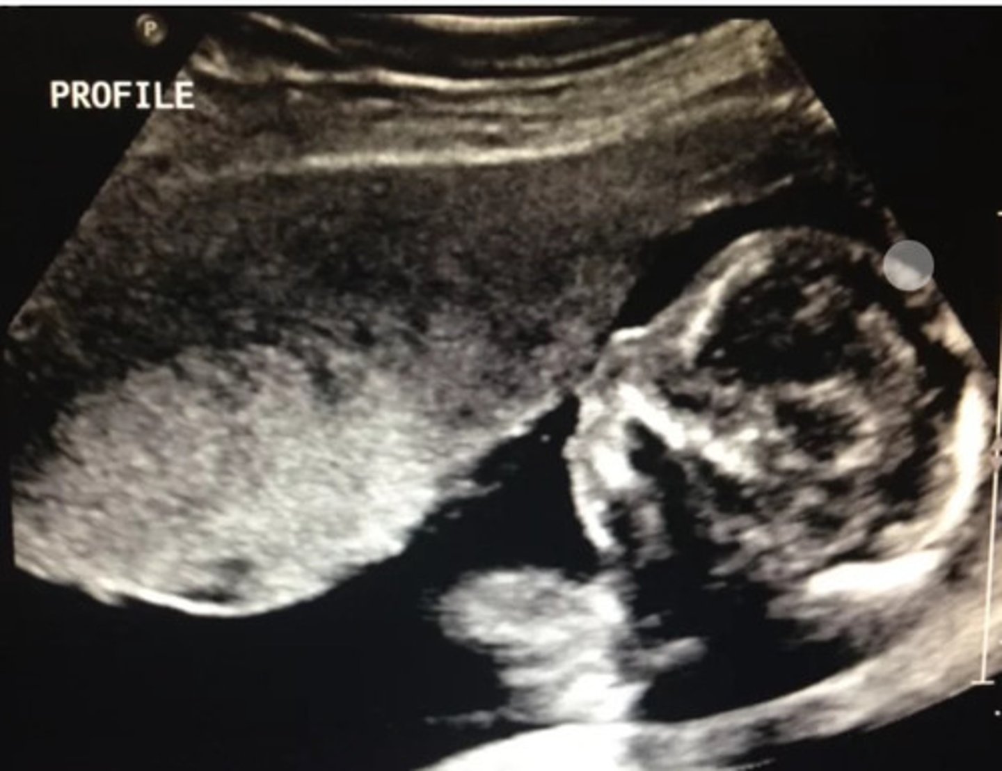 <p>Absent nasal bone and microcephaly</p>