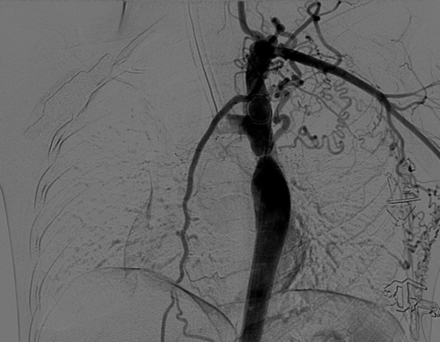 <p>Symptomatic in early childhood, tubular hypoplasia of the aortic arch, occurs proximal to a PDA.</p>