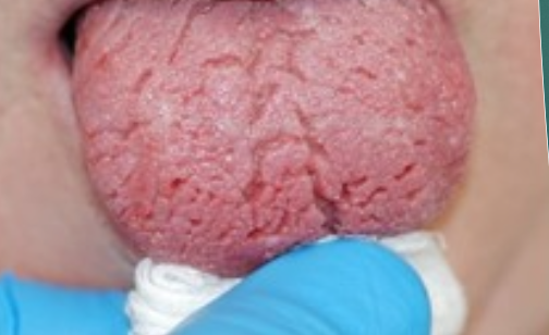 <p>What is xerostomia?</p>