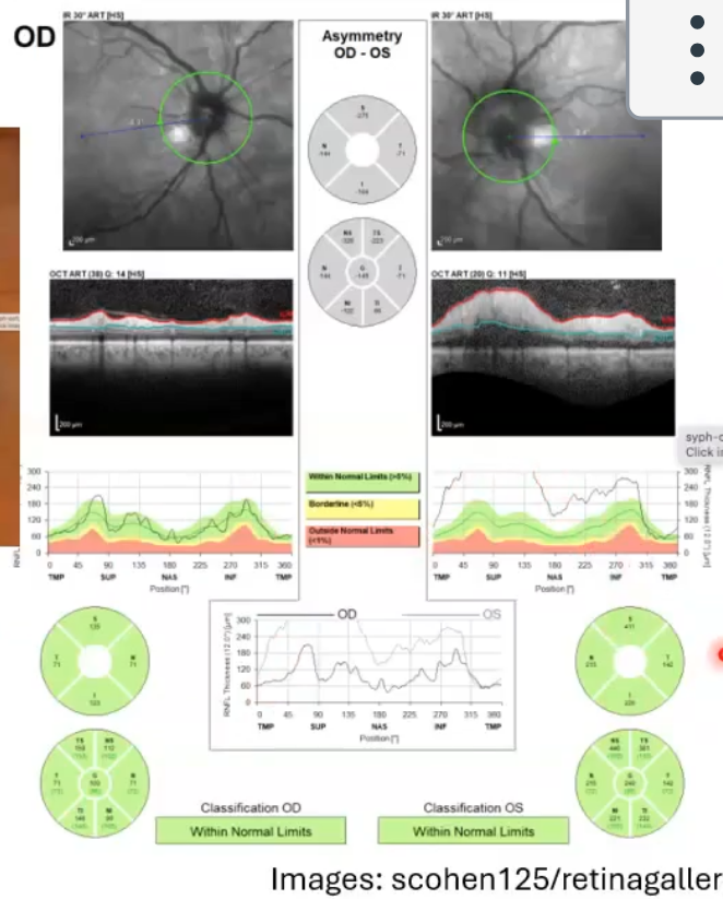 <p>inflammation of the optic nerve </p><p>swelling and haemorrhage of the left onh </p><p>lernfl thickness above normal limits </p><p>re rnfl thickness within normal limits </p>
