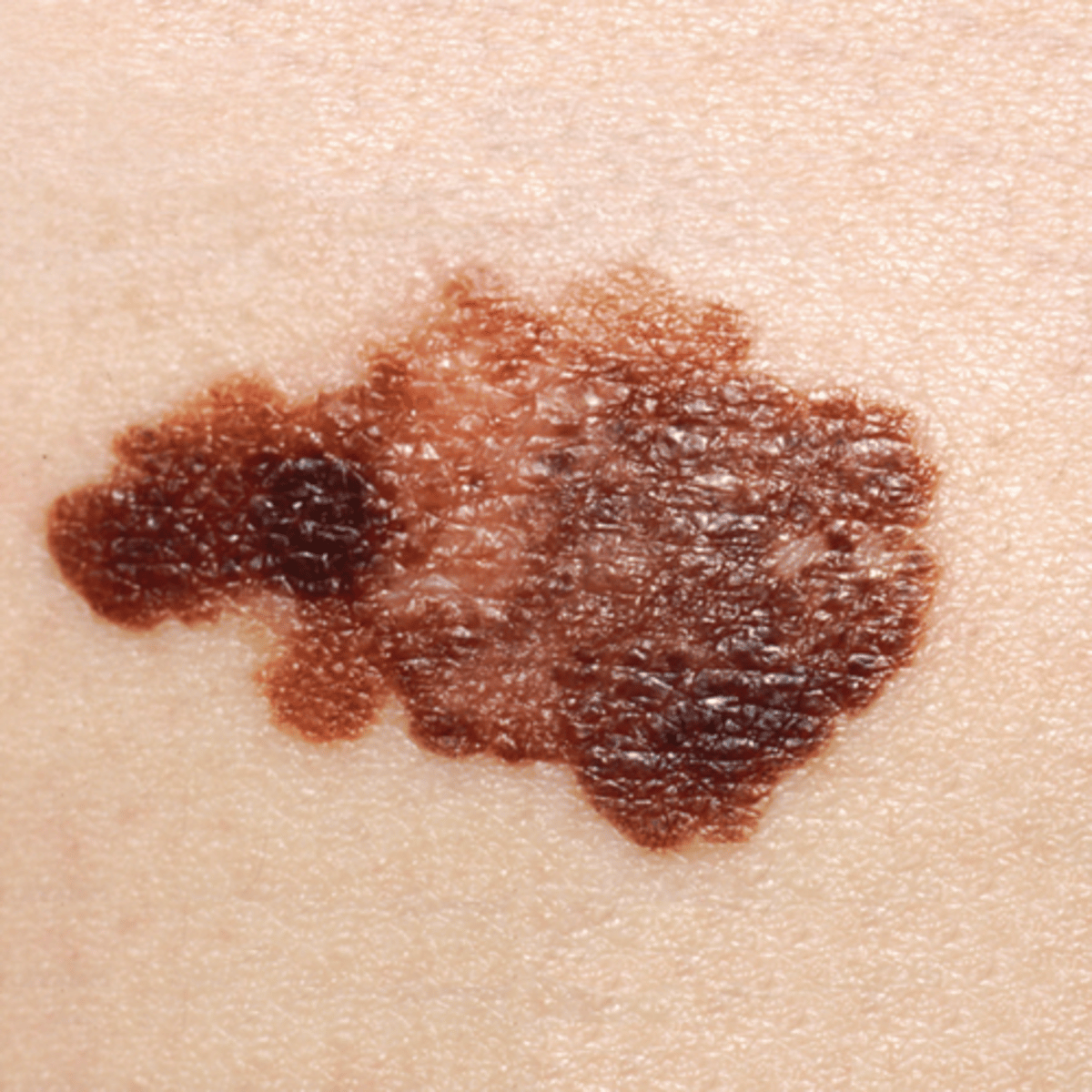 <p>Most serious form of skin cancer; Extremely dangerous</p><p>Cancerous melanocytes grow rapidly and metastasize through lymphatic system; If detected early and removed surgically, the 5-year survival rate is 99 percent; If not detected until after metastasis, the 5-year survival rate drops to 14 percent</p>