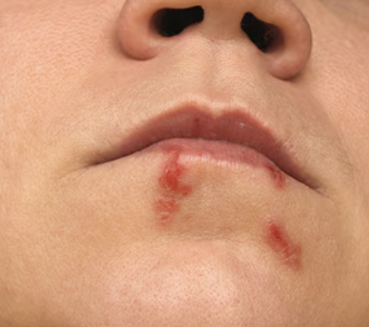 <p>what type of secondary lesion is this? (alteration to skin integrity)</p>