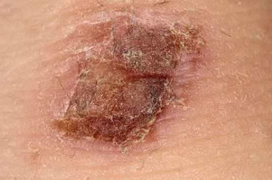 <p>what type of secondary skin lesion is this? (debris on skin surface)</p>