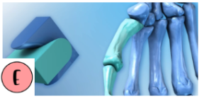 <p>In the hand, the thumb’s saddle joint lets the thumb cross over the palm, making it opposable (Trapezium, and the first metacarpal).</p>