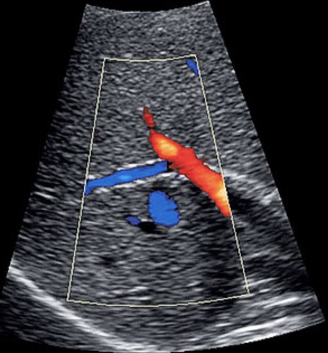 <p>Porta hepatis, MPV, anterior RPV, HA: red</p><p>Posterior RPV : blue</p>
