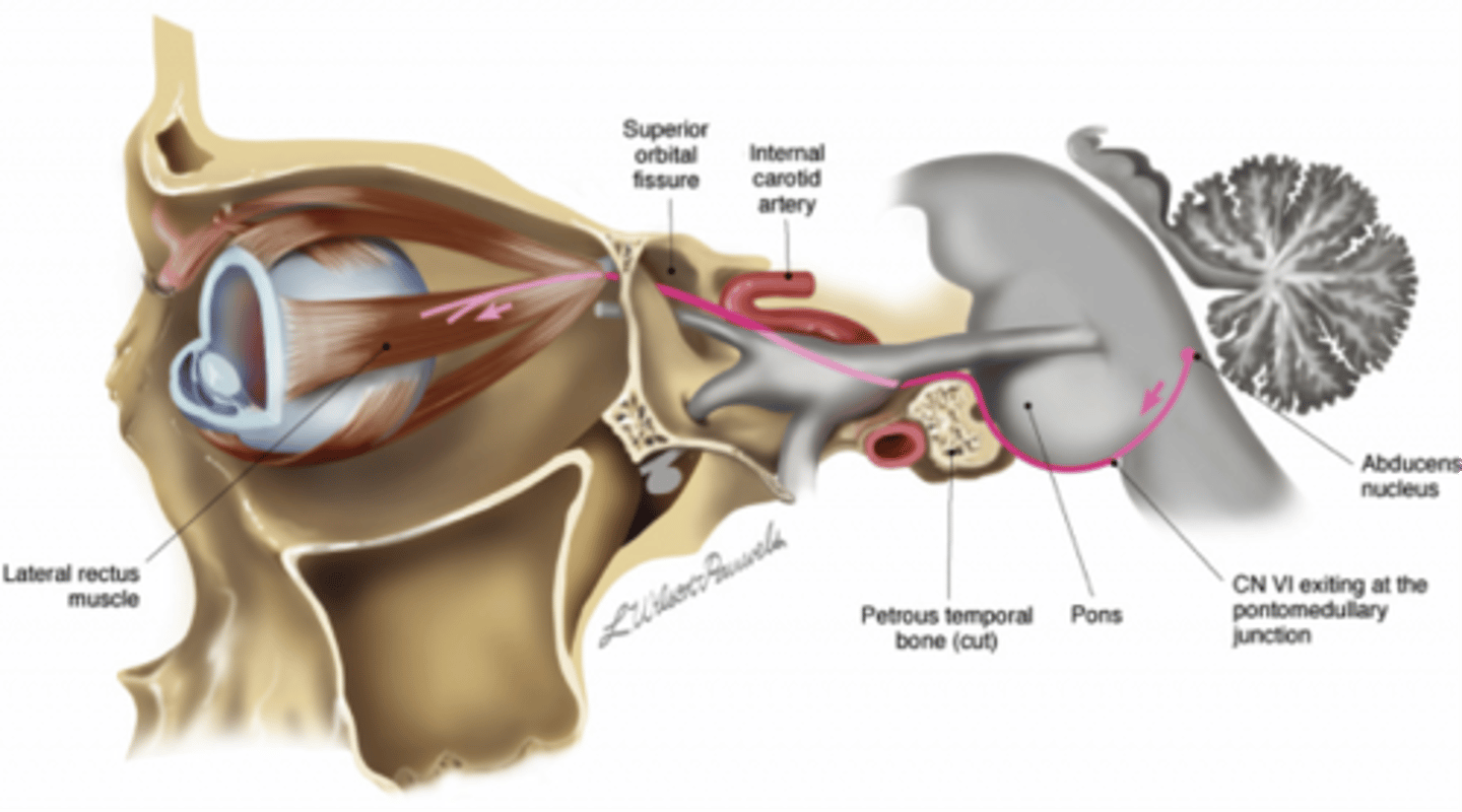 <p>1. change in intracranial pressure → pushes nerve against petrous portion of temporal bone</p><p>2. diabetes, HTN</p>