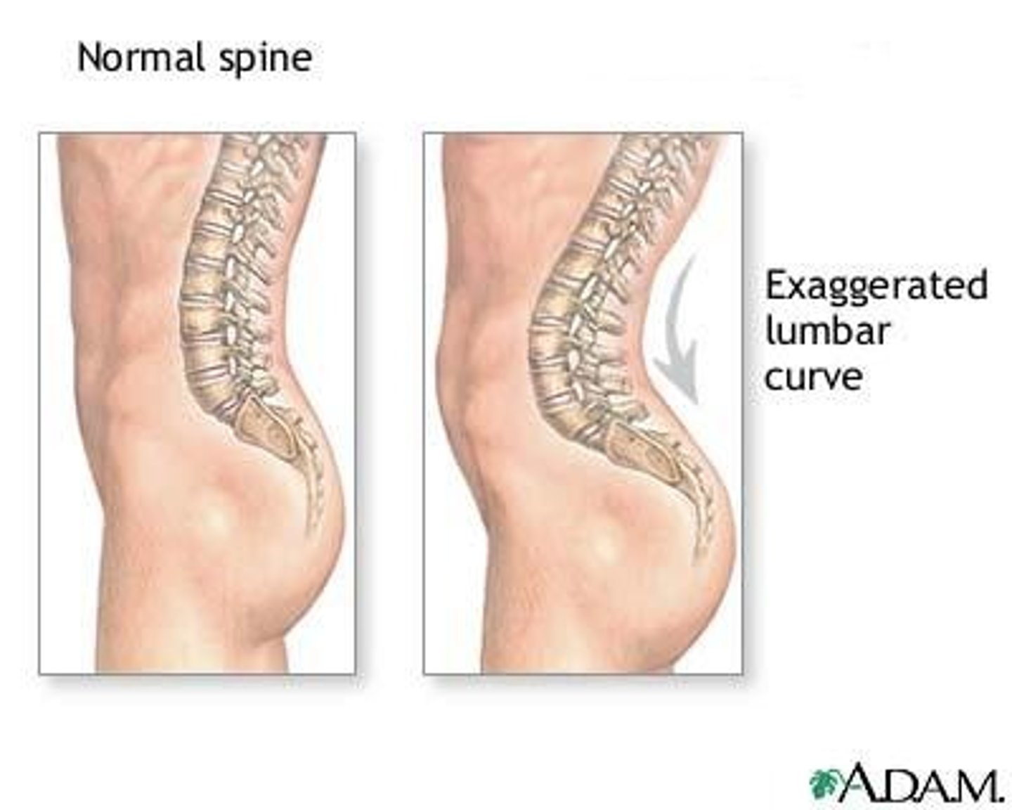 <p>Swayback</p><p>Spine of person curves significantly inward at the lower back</p>